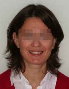 Лечение височно-нижнечелюстного сустава (ВНЧС) фото 3