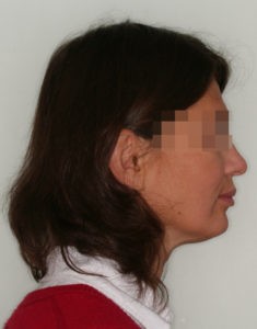 Лечение височно-нижнечелюстного сустава (ВНЧС) фото 4 Лечение височно-нижнечелюстного сустава (ВНЧС) фото 4