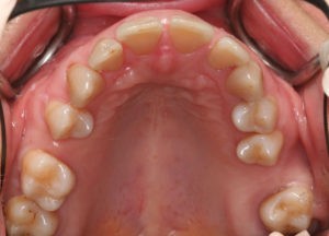 Дисфункция височно-нижнечелюстного сустава фото 1 Дисфункция височно-нижнечелюстного сустава фото 1