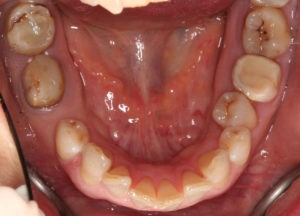 Дисфункция височно-нижнечелюстного сустава фото 2 Дисфункция височно-нижнечелюстного сустава фото 2
