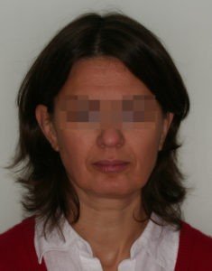 Лечение височно-нижнечелюстного сустава (ВНЧС) фото 1