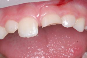 Реставрация зубов в клинике Ортокон Харьков фото