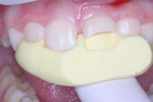 Реставрация зубов в клинике Ортокон Харьков фото 4