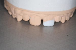 Реставрация зубов в клинике Ортокон Харьков фото 5