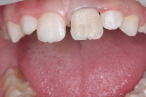 Реставрация зубов в клинике Ортокон Харьков фото 6