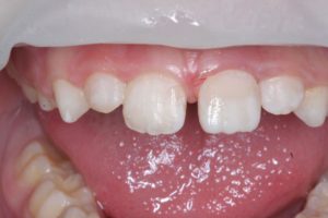 Реставрация зубов в клинике Ортокон Харьков фото 7