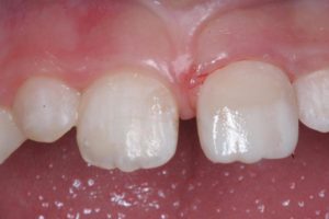 Реставрация зубов в клинике Ортокон Харьков фото 8