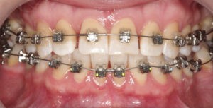 Установка брекет-системы фото