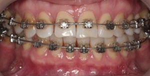 Установка брекет-системы фото 3