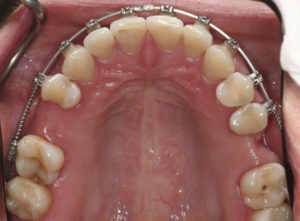Установка брекет-системы фото 5