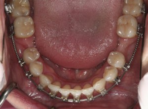 Установка брекет-системы фото 6