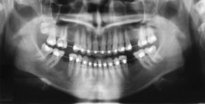 Панорамный снимок положения корней зубов фото