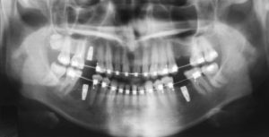 Панорамный снимок положения корней зубов фото 2