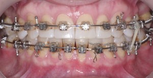 Детализация отдельных зубов фото