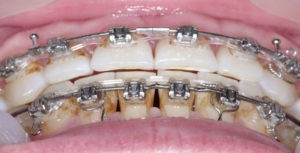 Установка формирователей десны фото