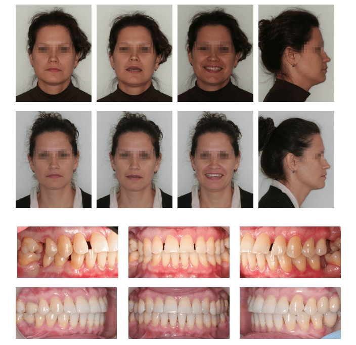 Металлокерамическими реставрации фото