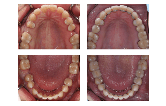 Металлокерамическими реставрации фото 2