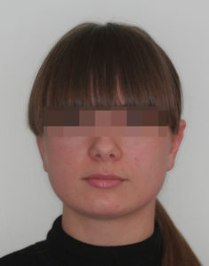 Лечение височно-нижнечелюстного сустава фото