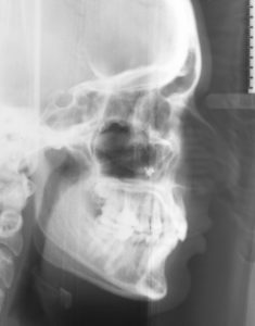 Рентген зуба при лечении ВНЧС фото