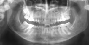Рентген зуба при лечении ВНЧС фото 2