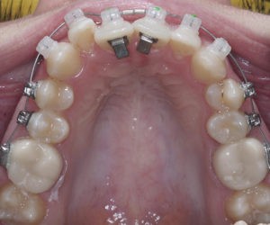 Установка и фиксация брекетов фото