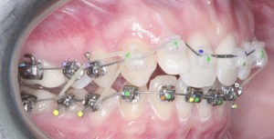 Установка и фиксация брекетов фото 2