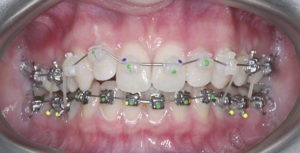 Установка и фиксация брекетов фото 3