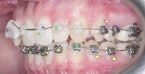 Установка и фиксация брекетов фото 4