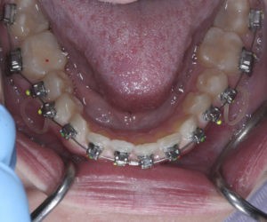 Установка и фиксация брекетов фото 4