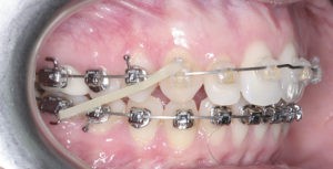 Установка брекетов фото