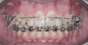 Установка брекетов фото 2