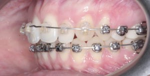 Панорамный снимок зубов (ОПТГ) фото 3