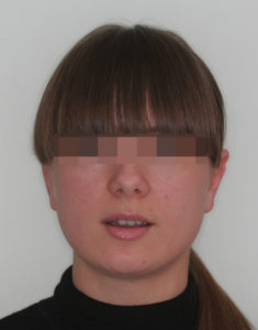 Лечение височно-нижнечелюстного сустава фото 2