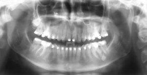 Панорамный снимок зубов (ОПТГ) фото