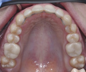 Снятие брекетов на зубах верхней и нижней челюстей фото