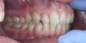 Снятие брекетов на зубах верхней и нижней челюстей фото 2