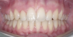 Снятие брекетов на зубах верхней и нижней челюстей фото 3