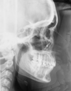 Снимок зубов после лечения фото