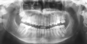 Снимок зубов после лечения фото 2