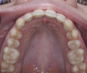 Замена пластмассовых коронок на металические фото