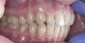 Замена пластмассовых коронок на металические фото 2