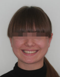 Лечение височно-нижнечелюстного сустава фото 3