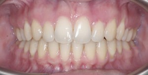 Замена пластмассовых коронок на металические фото 3