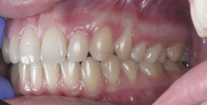 Замена пластмассовых коронок на металические фото 4