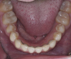 Замена пластмассовых коронок на металические фото 5