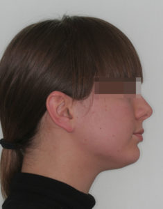 Лечение височно-нижнечелюстного сустава фото 4