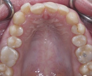 Лечение дисфункции ВНЧС фото