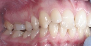 Дисфункция внчс лечение фото