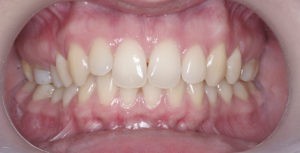 Дисфункция внчс лечение фото 2