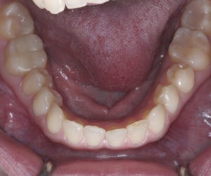 Лечение дисфункции ВНЧС зубов фото